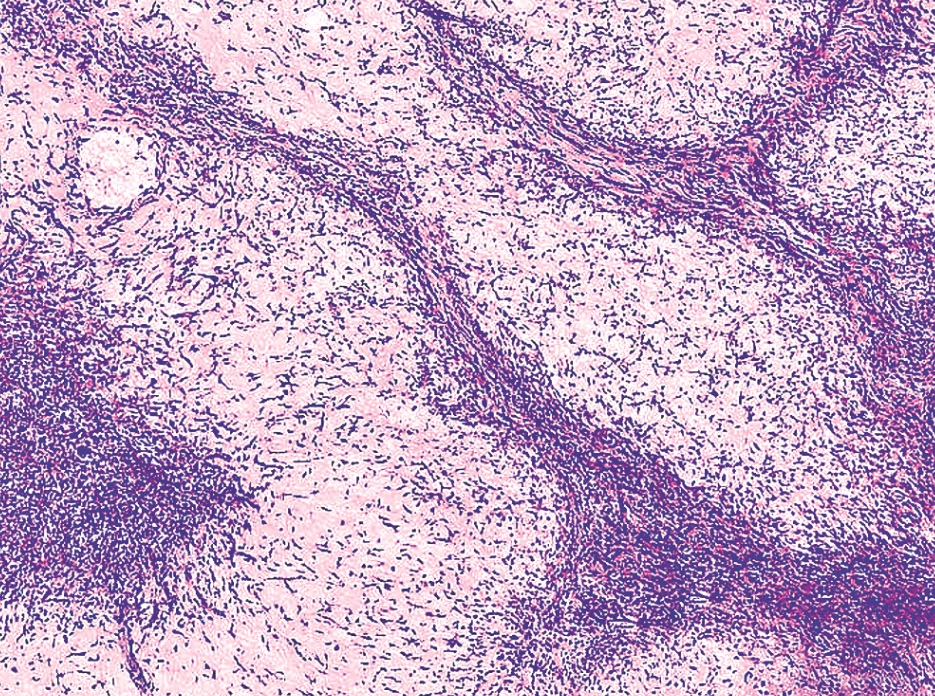 Pathology Outlines Chondromyxoid Fibroma 2075